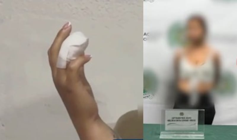 Patrullera en Bogotá fue mordida en la mano y casi pierde un dedo durante una pelea en vía pública