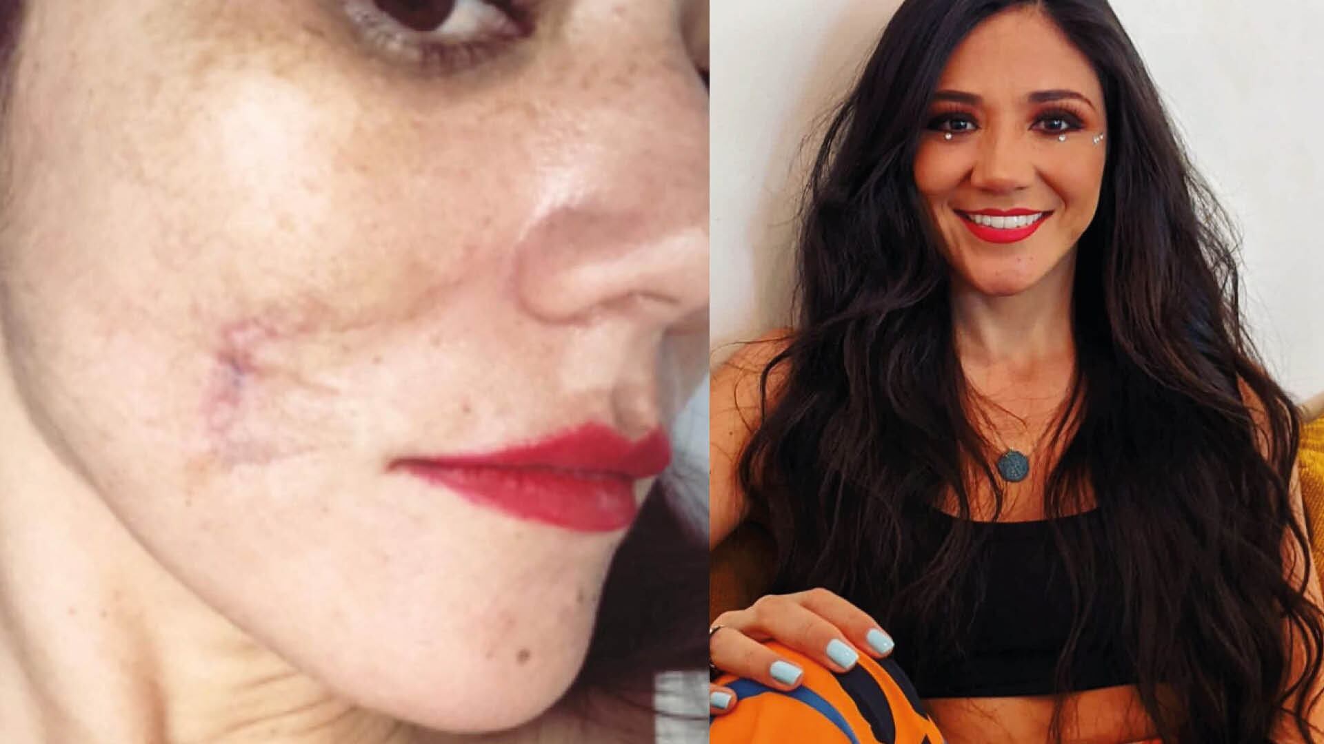 Periodista Nathaly Toledo muestra la cicatriz en su rostro debido al accidente que tuvo con su perro