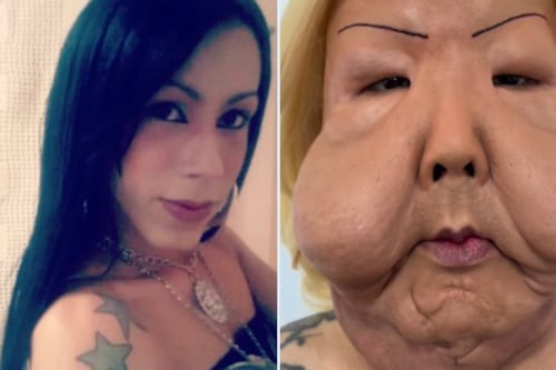 Influencer sufre graves lesiones faciales por un tratamiento estético clandestino