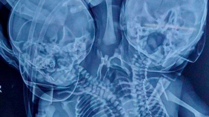 Un bebé nace con dos cabezas, tres brazos y dos corazones en la India
