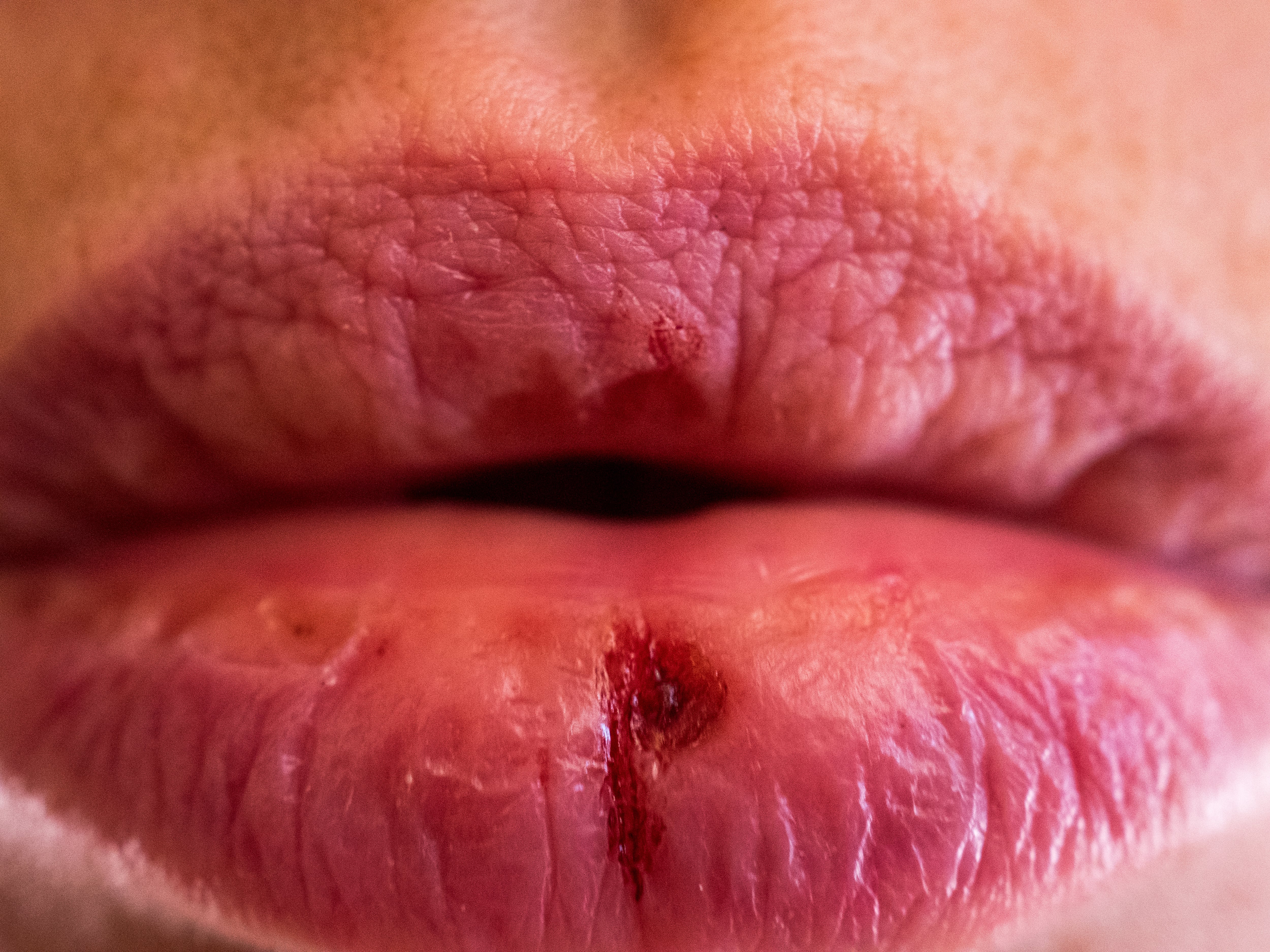 Pensó que era herpes, pero tenía sífilis: así descubrió la enfermedad