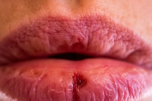 Pensó que era herpes, pero tenía sífilis: así descubrió la enfermedad