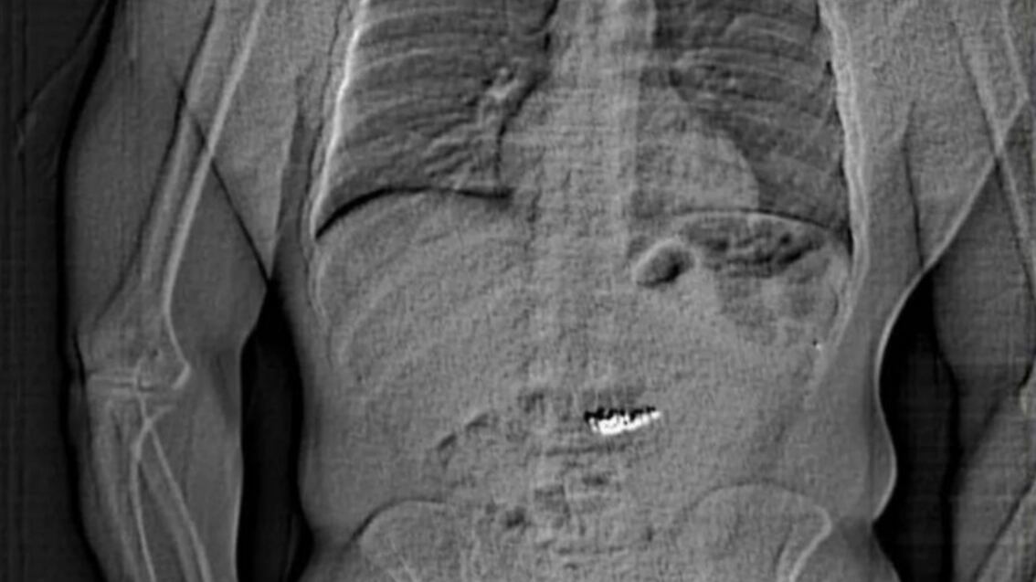 Ladrón se traga aretes de más de medio millón de dólares antes de ser arrestado