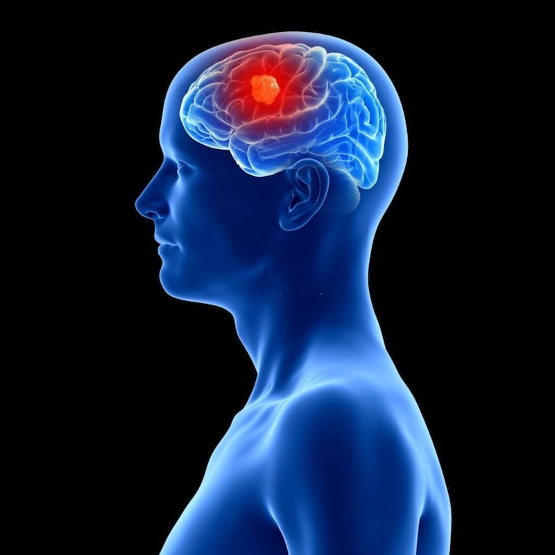 Tumor cerebral