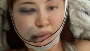 “Me desmayé del dolor”: así terminó el rostro de una mujer que se realizó una lipopapada en México - Fuente: Foto de la web