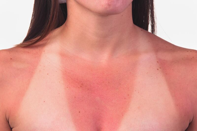 Medidas si te quemaste por el sol en tu feriado