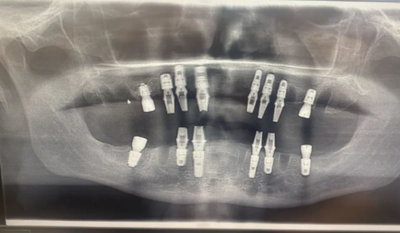 Viajó para arreglarse los dientes y terminó sin poder comer. Foto: The Sun