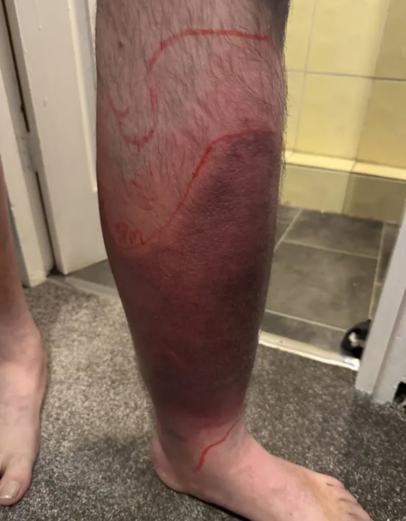 Hombre casi pierde la pierna tras rasparse en las escalera de la piscina en vacaciones. Imagen: The Sun