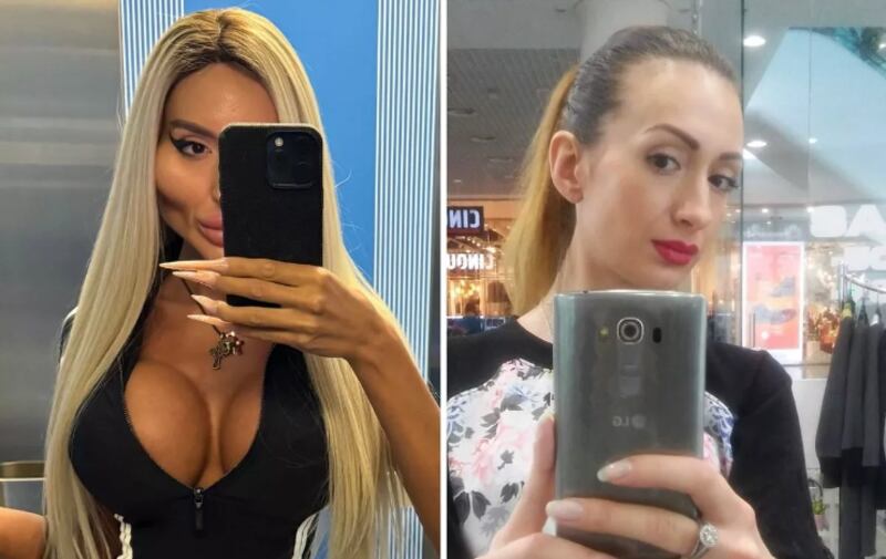 Así lucía la mujer con las “las mejillas más grandes del mundo” antes de su cirugía.