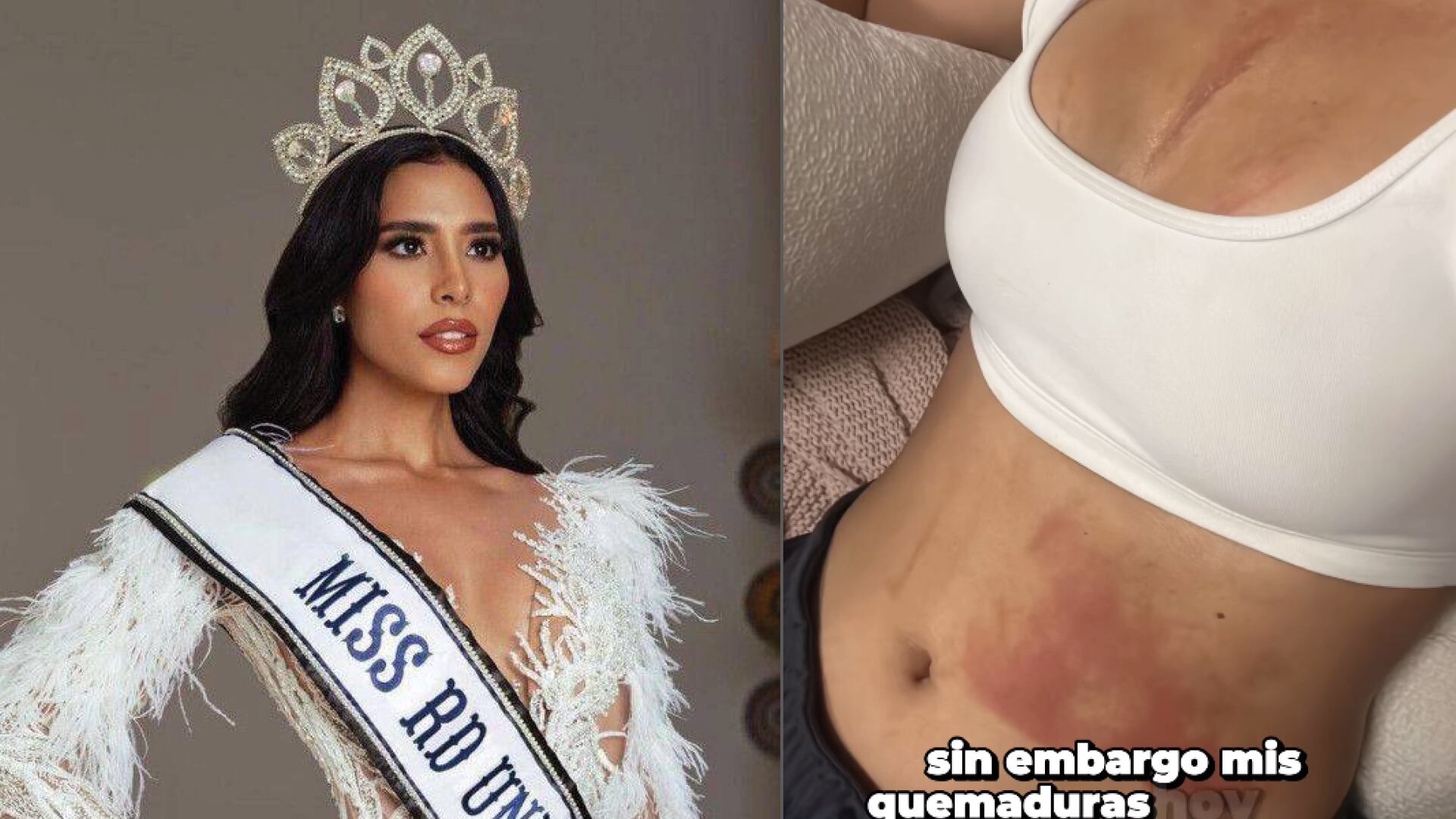 Exreina de belleza le explotó la olla de presión en su rostro: "No se lo deseo a nadie"