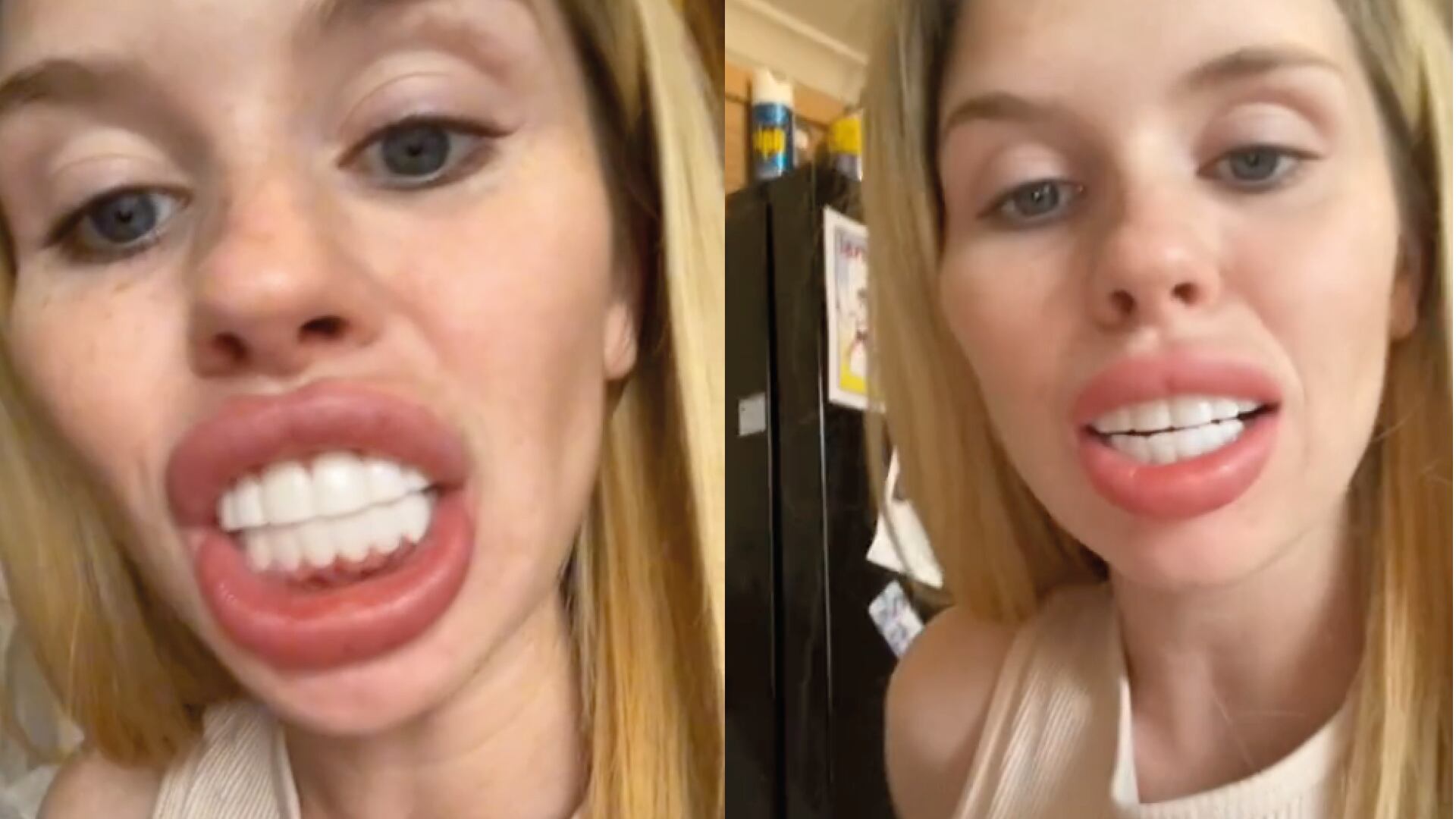 Joven que quedó como un caballo mostró su resultado en TikTok