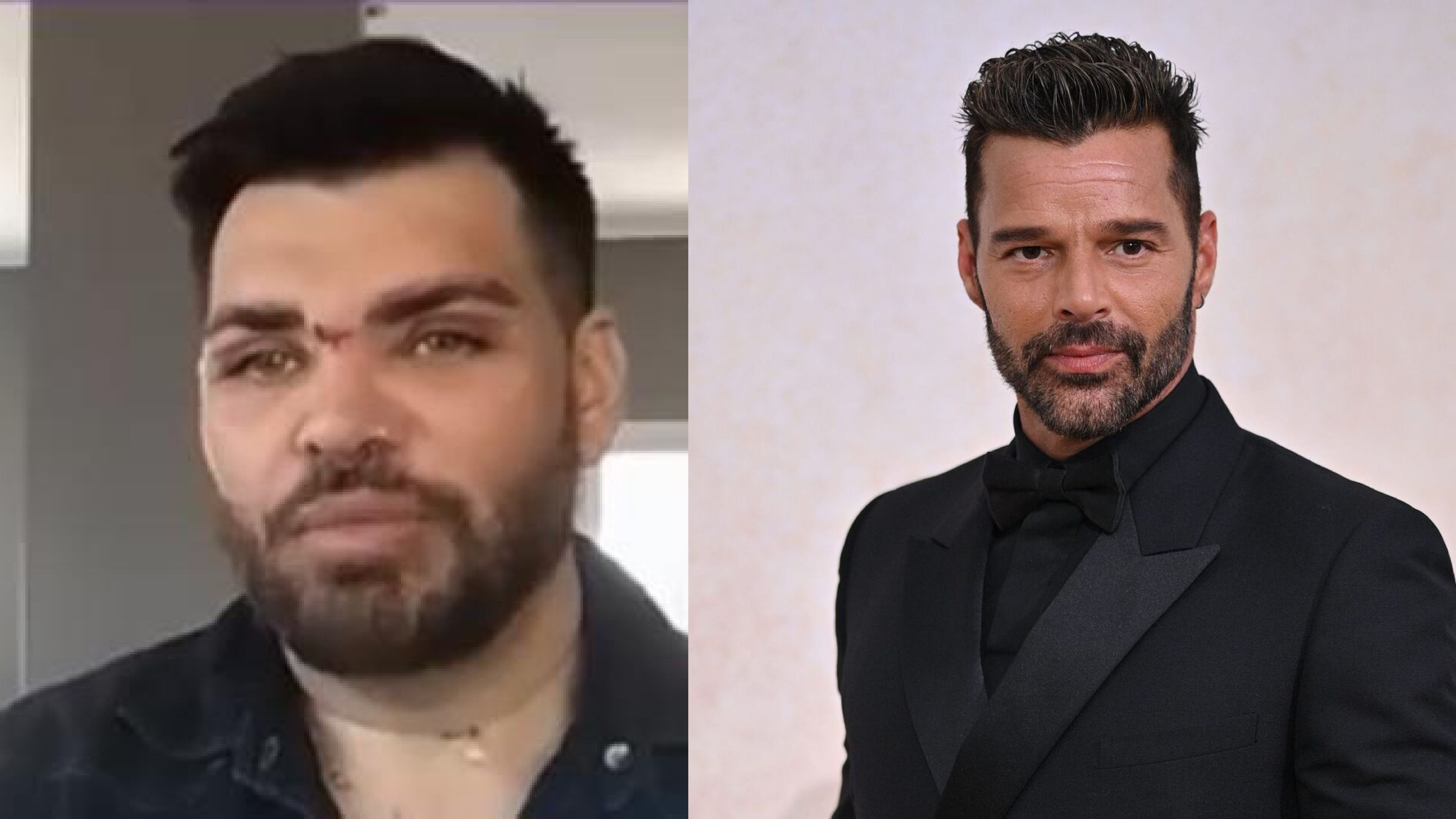 Argentino pasa por más de 30 cirugías para parecerse a Ricky Martin y sus resultados fueron fatales: "Hasta aceite de motos me inyectaron"