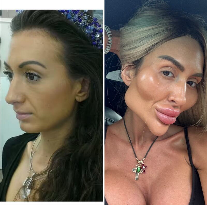 Así lucía la mujer con las “las mejillas más grandes del mundo” antes de su cirugía