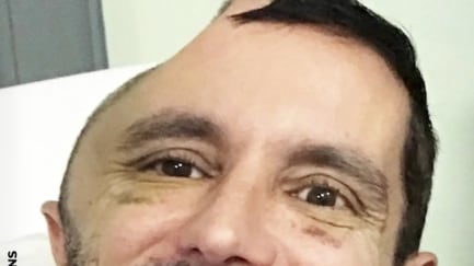 “Podía tocarme el cerebro”: hombre sufrió grave lesión en la cabeza tras caer por las escaleras“Podía tocarme el cerebro”: hombre sufrió grave lesión en la cabeza tras caer por las escaleras - Fuente: Foto de la web