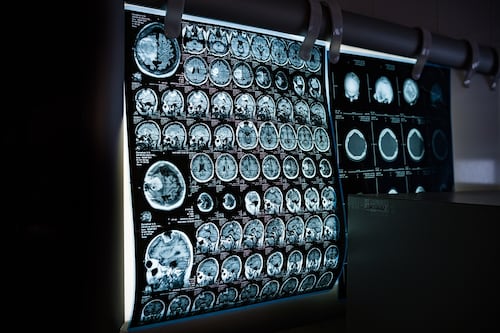 Una de cada tres personas en el mundo padece trastornos neurológicos, según la OMS