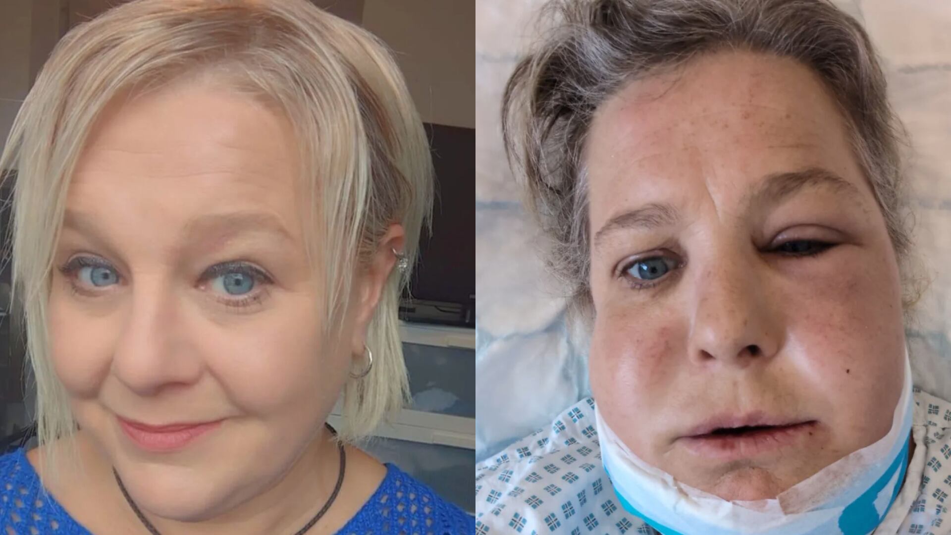 Una rara infección bucal casi acaba con la vida de una mujer en Inglaterra