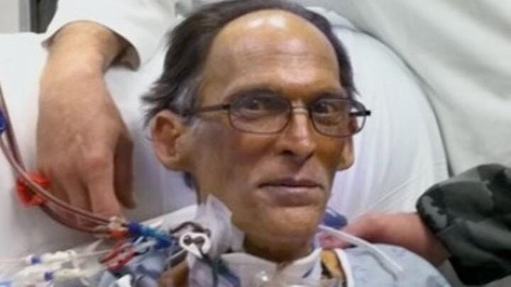 'primer ser humano sin corazón' vivió un mes sin pulso debido a una operación radical.