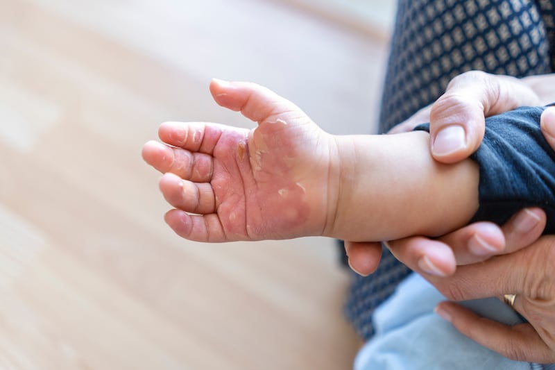 Quemaduras en niños