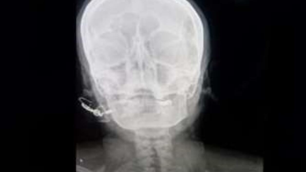 Curandero incrustó un clavo en la cabeza de una mujer embarazada para que “tuviera un varón”