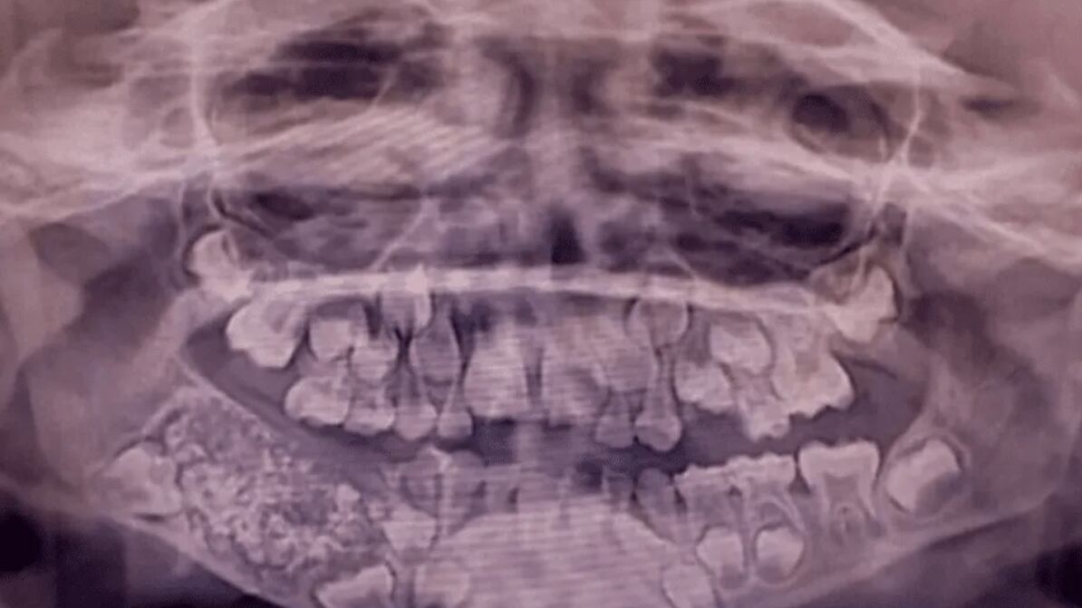 Niño con más de 500 dientes