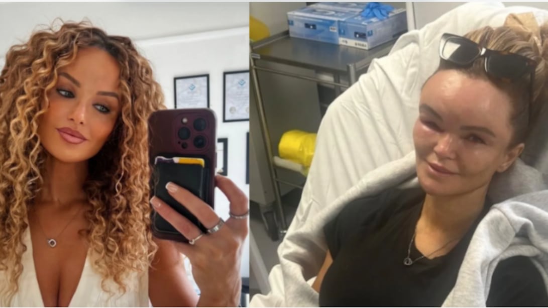 Mujer revela cómo comenzó enfermedad que deformó su rostro tras el estrés