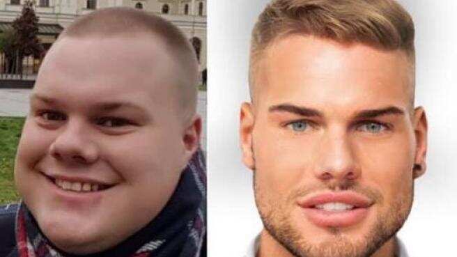 Joven cambia su rostro con cirugías plásticas