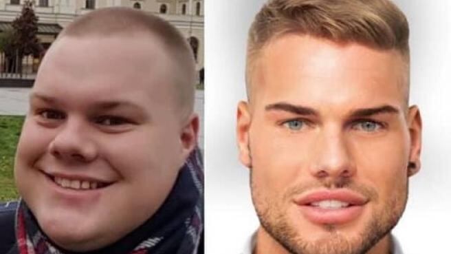 Joven cambia su rostro con cirugías plásticas