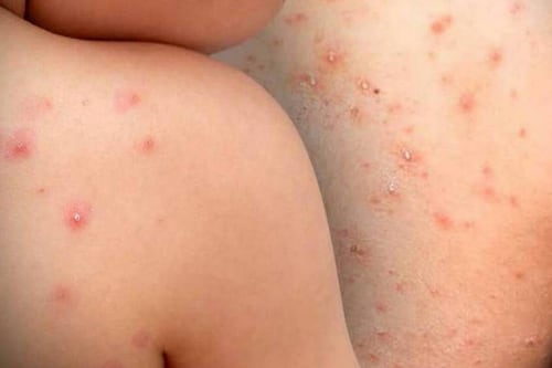 Viruela símica: Municipio de Guayaquil activa protocolos y difunde síntomas de alerta