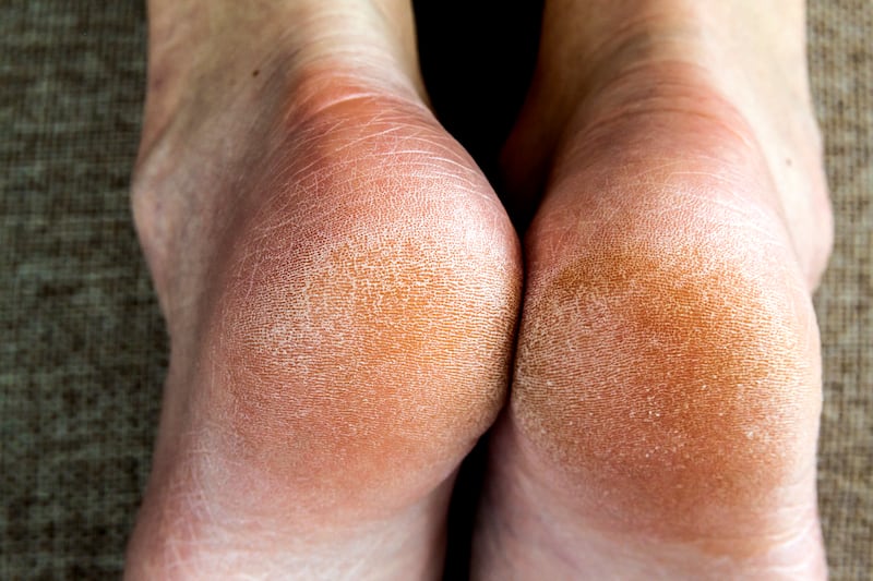 callos en los pies