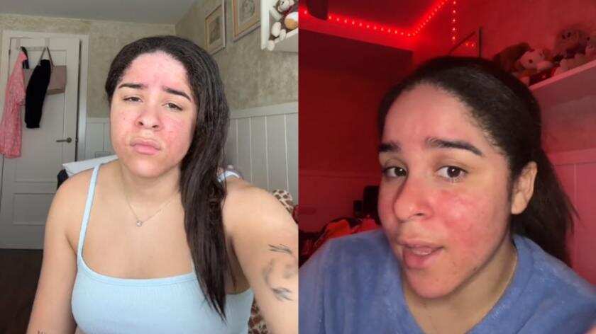 María Botella es una joven alérgica al agua