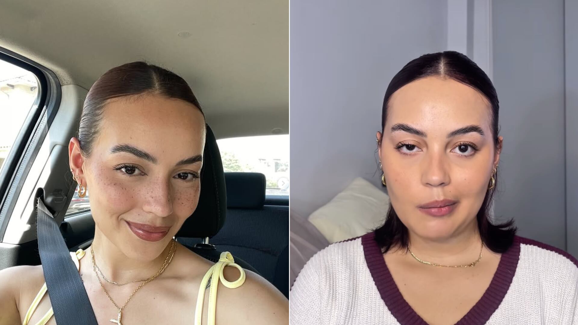 El antes y después de modelo que sufrió graves secuelas tras comer sushi contaminado en Ecuador