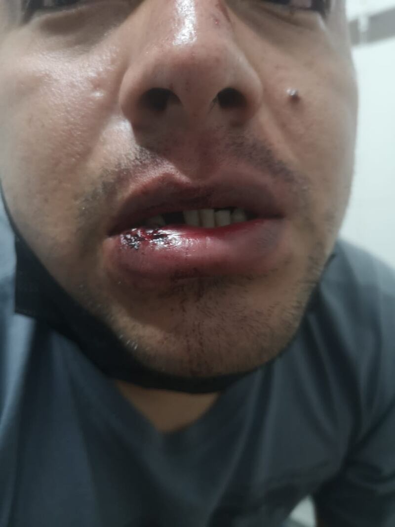 Secuelas de las víctimas de abuso policial al norte de Quito