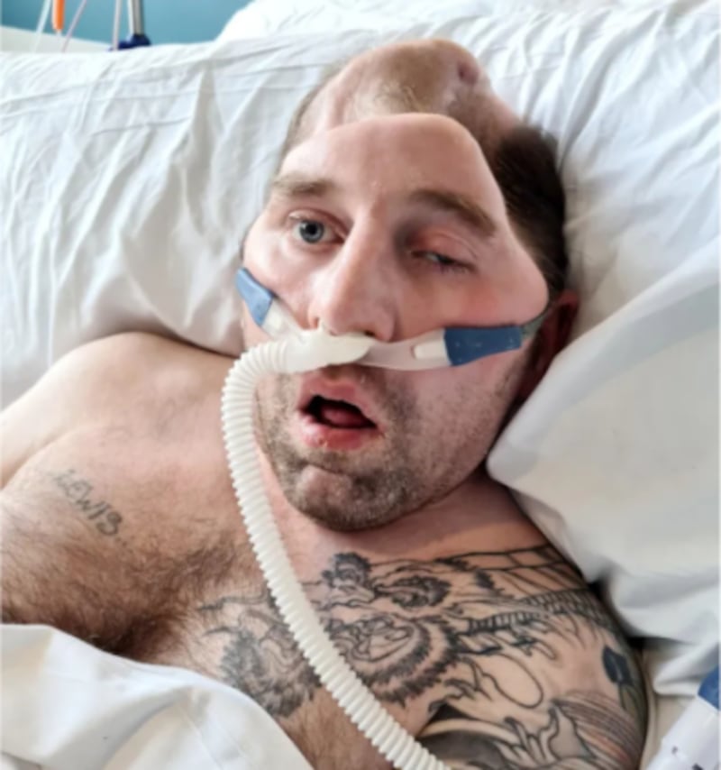 Hombre fallece siete años después de que un desconocido le diera un puño en la cara; lo dejó sin habla y con daño cerebral