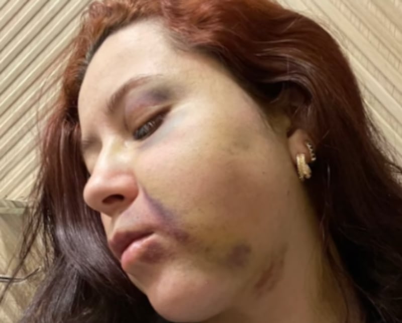 “Me desmayé del dolor”: así terminó el rostro de una mujer que se realizó una lipopapada en México - Fuente: Foto de la web