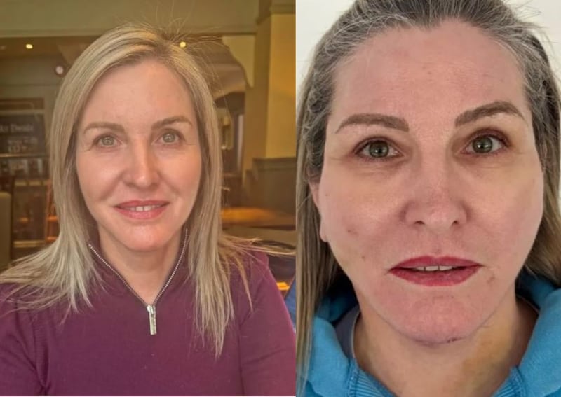 Leigh Cobb pagó US$1.600 por un lifting exprés que le dejó marcas permanentes en el rostro.