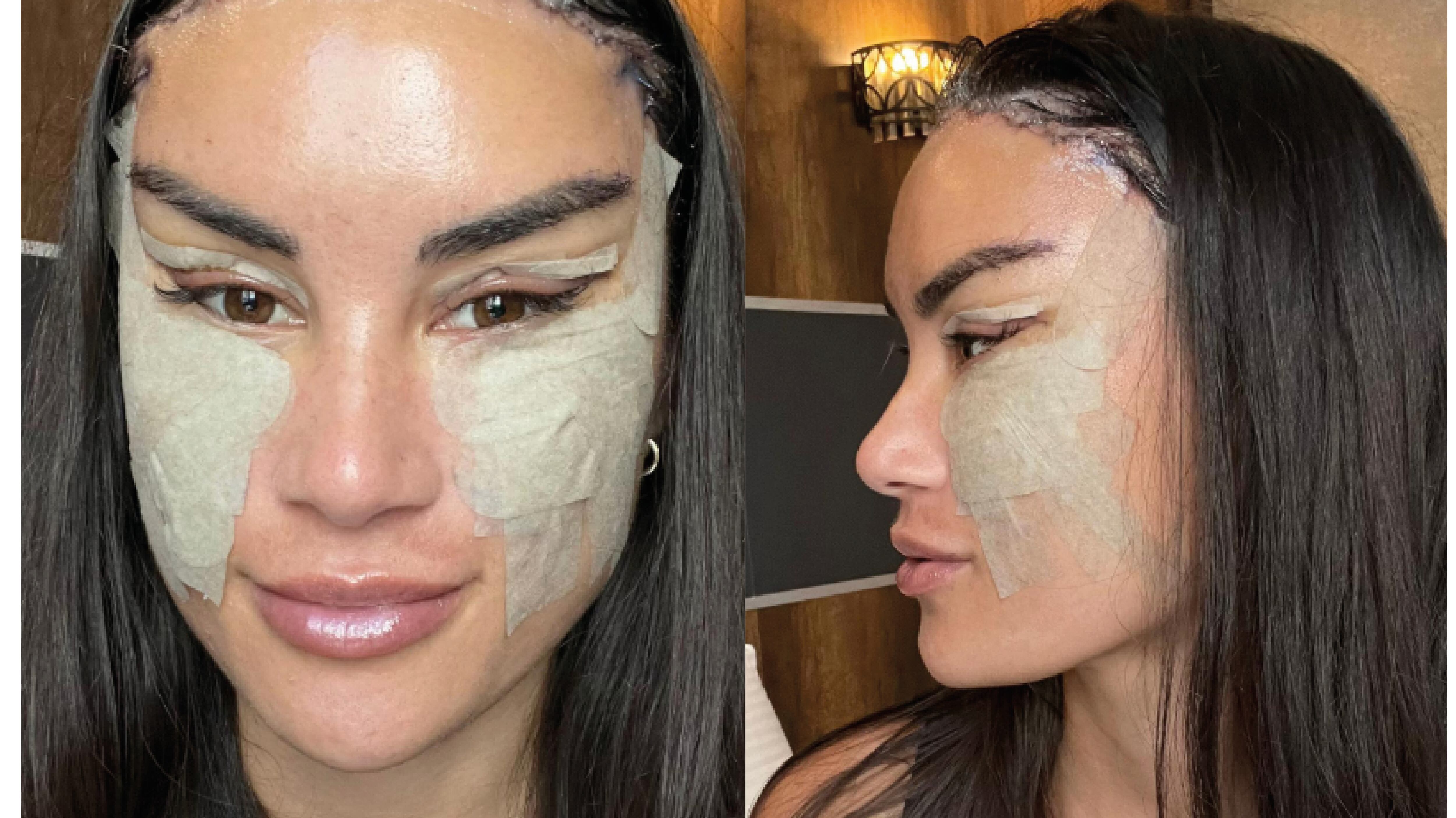 Mujer se hizo una reducción de frente y otras cirugías y su cambió encendió las redes