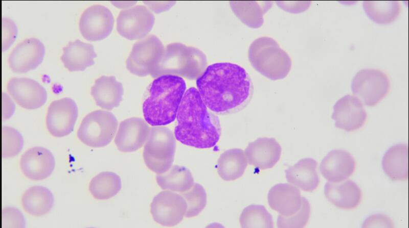 Linfoma folicular