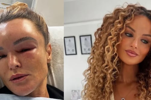 Profesora queda ciega y desfigurada tras accidente: no puede salir de su casa