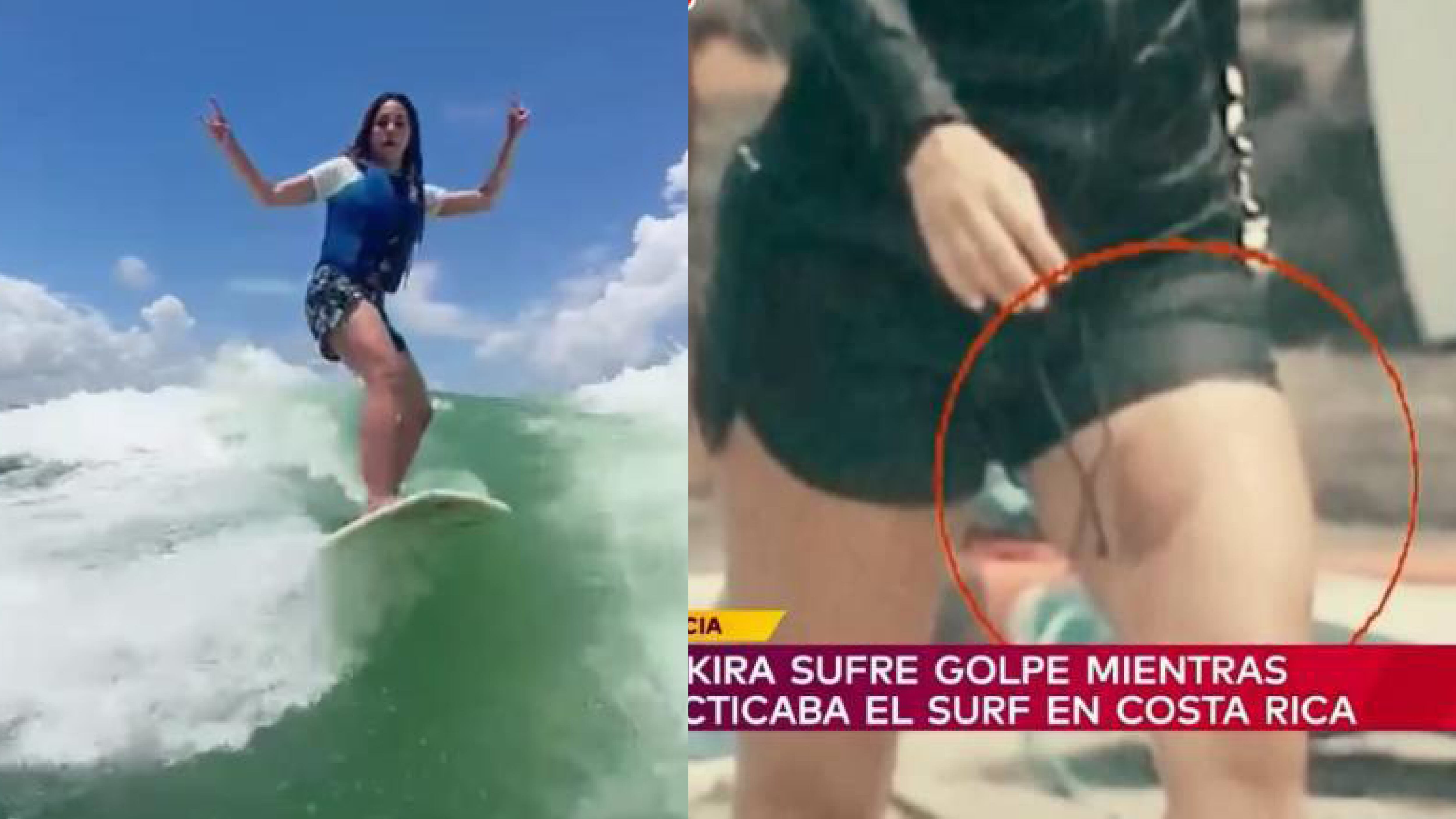 Shakira tuvo un accidente mientras surfeaba en Costa Rica: Se filtraron las fotos de los golpes