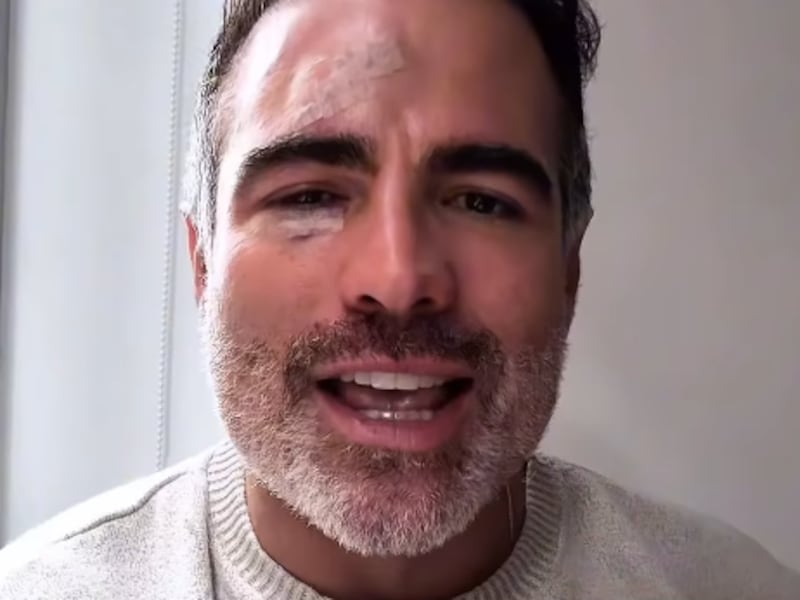 ¿Qué le pasó en el rostro a Roberto Manrique? Así quedó su rostro después de accidente