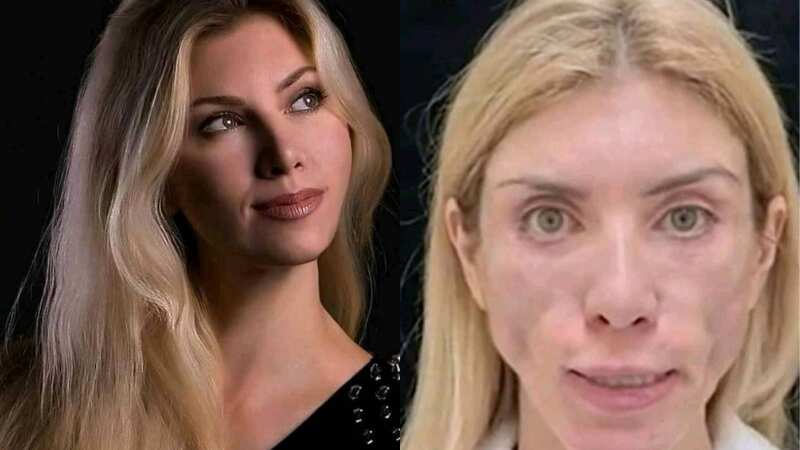 Modelo rusa realiza cirugía plástica y ahora no logra sonreír y cerrar los ojos