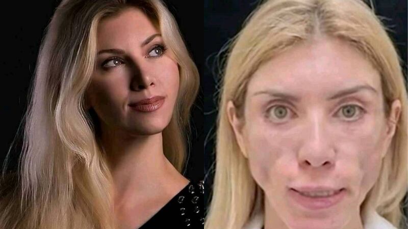 Modelo rusa realiza cirugía plástica y ahora no logra sonreír y cerrar los ojos