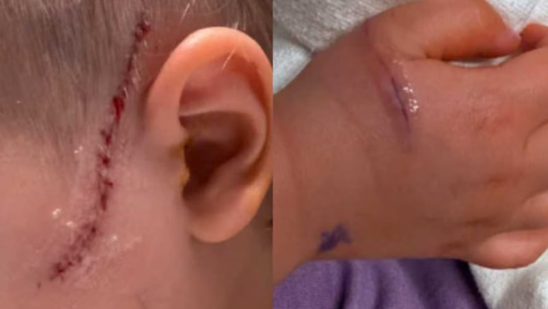 El menor sufrió cortes en el rostro y la mano, lesiones por las que debió recibir atención quirúrgica especializada en un hospital pediátrico (Familia Hillman)