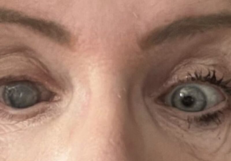 Mujer perdió la vista de su ojo derecho por usar lentes de contacto