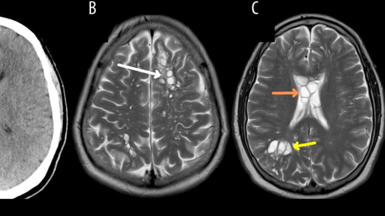 Paciente con larvas en el cerebro
