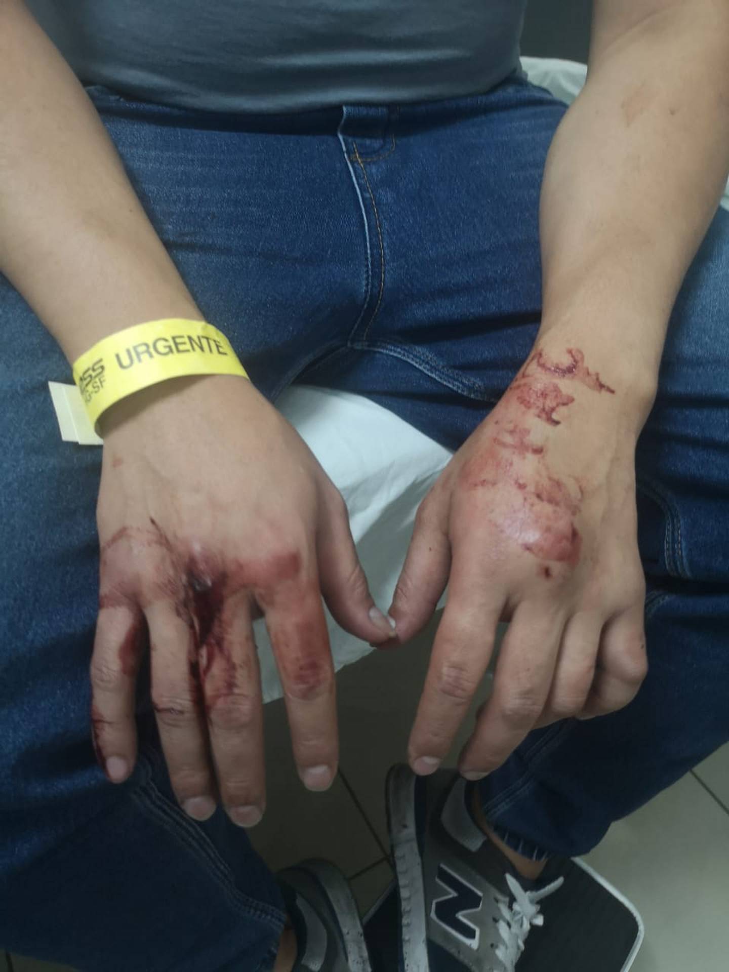 Secuelas de las víctimas de abuso policial al norte de Quito